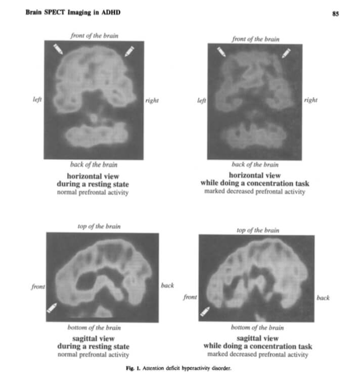 Brain Spect Imaging in ADHD During a resting state & during a concentration task. Dr. Daniel Amen